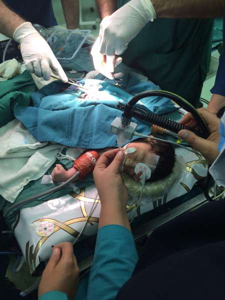 جراحی موفقیت آمیز مغز بر روی نوزاد یک روزه در شهرستان فسا