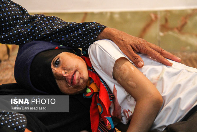 عکس منتخب سال - ۲۸ فروردین - رعنا و مادرش سمیه چند سال قبل توسط پدرش مورد اسیدپاشی واقع شد. مادر رعنا مدتی پس از حادثه فوت کرد. او حالا با خانواده مادرش در روستای همت آباد بم زندگی می‌کند. 