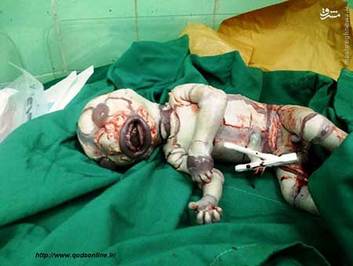 تولد یک نوزاد با یک بیماری وحشتناک در داراب