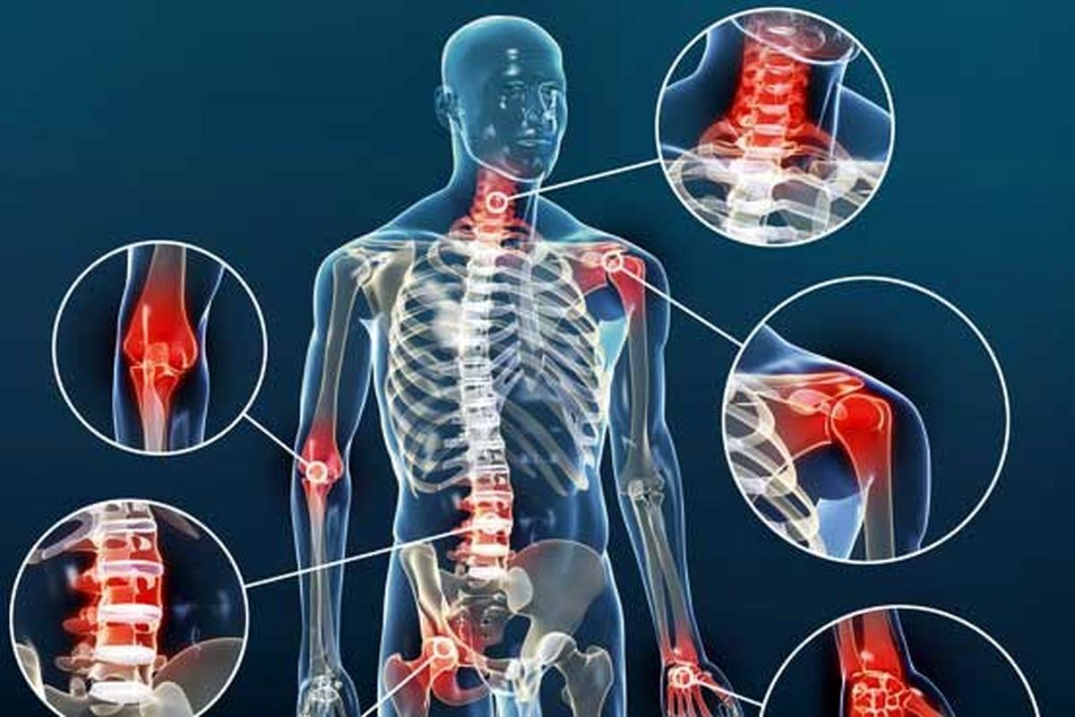 آرتروز شایع‌ترین بیماری مزمن مفاصل